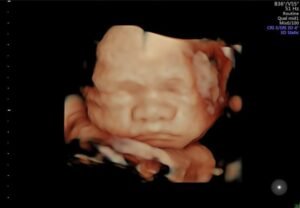 5D ultrasound scan