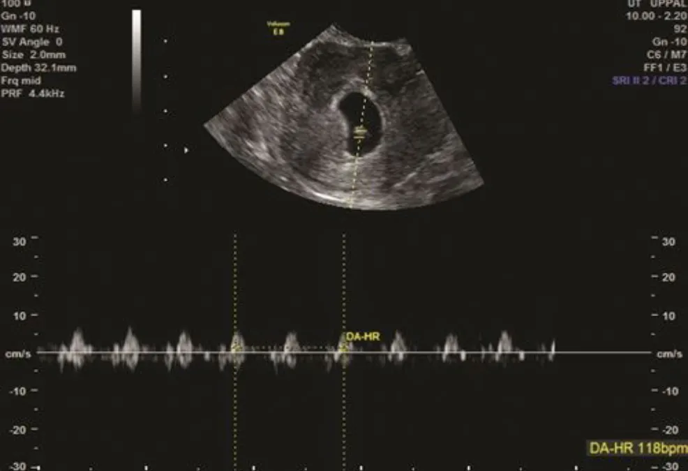 Heartbeat Details Scan Baby