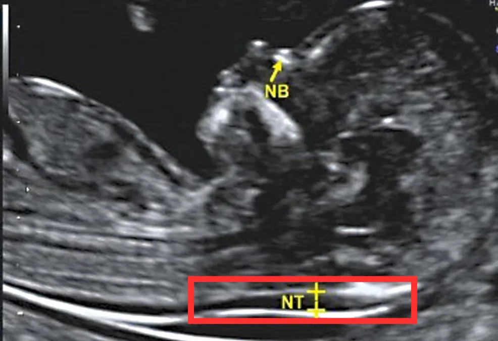 NT Details Scan Baby