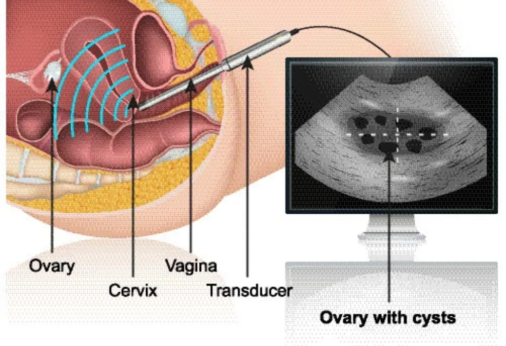Transvaginal Ultrasound Baby Scan