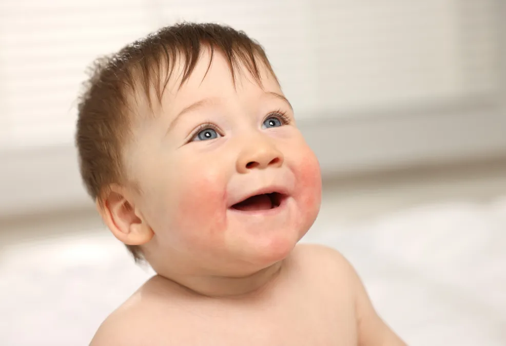 sedut-kahak-bayi-allergic