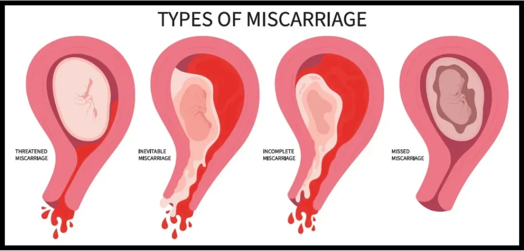 tanda-keguguran-missed-miscarriage